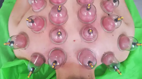 Köpölyözés – A testi-lelki harmónia ősi módszere Budapesten 3