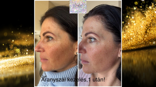 Anti-Aging kezelés bőrbe olvadó arany kollagén-peptidszálakkal arc területen 2